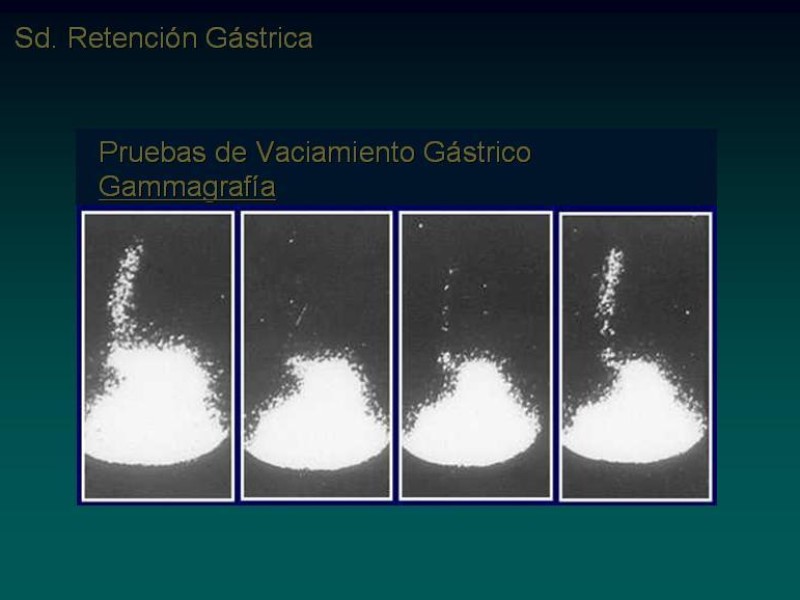 Diapositiva 17 de Síndrome Retención Gástrica