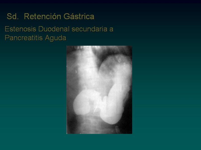 Diapositiva 8 de Síndrome Retención Gástrica