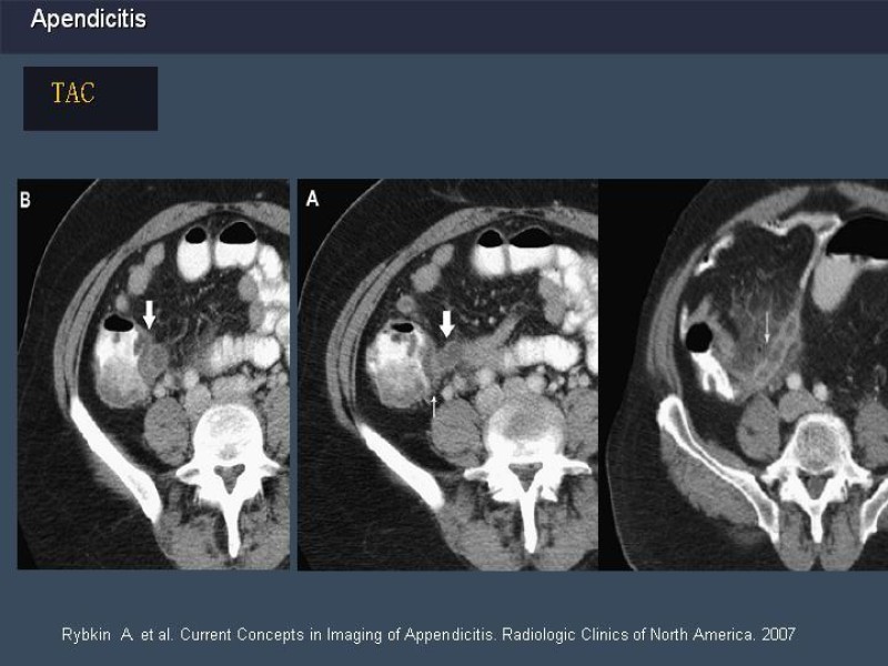 Diapositiva 21 de Apendicitis