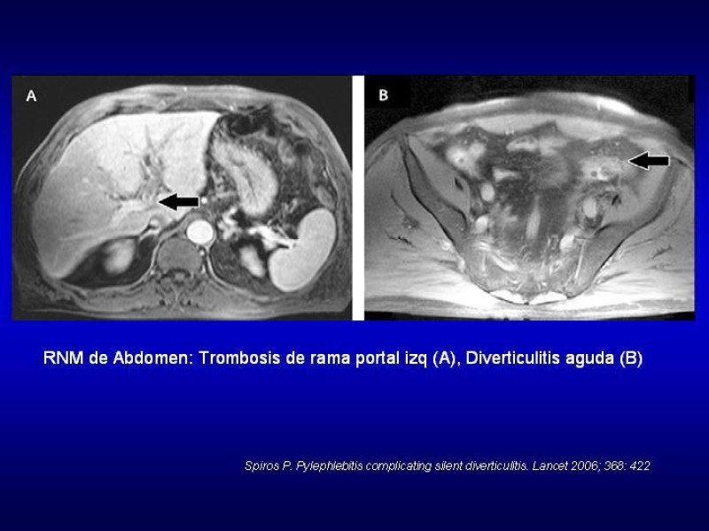 Diapositiva 14 de Pileflebitis
