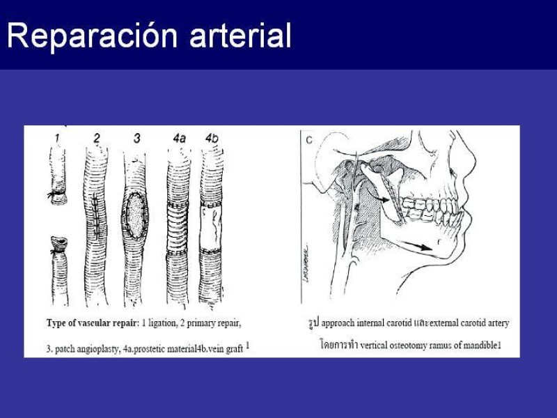Diapositiva 52 de Trauma Cervical Penetrante
