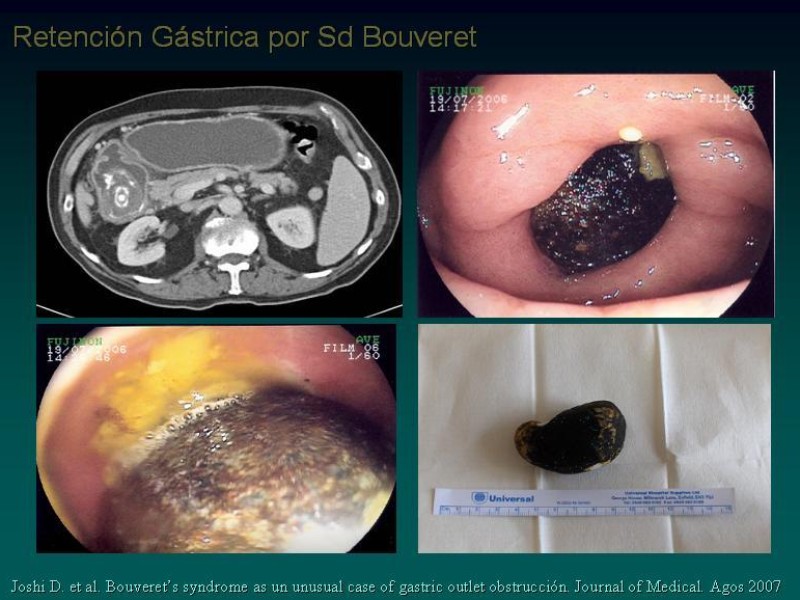 Diapositiva 10 de Síndrome Retención Gástrica