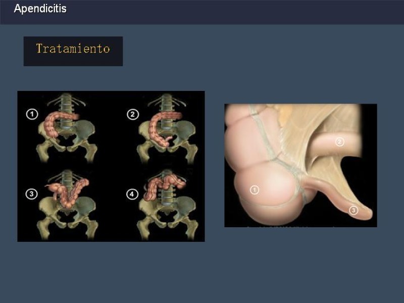 Diapositiva 26 de Apendicitis