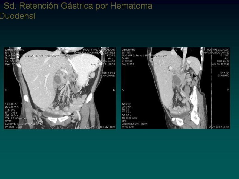 Diapositiva 11 de Síndrome Retención Gástrica