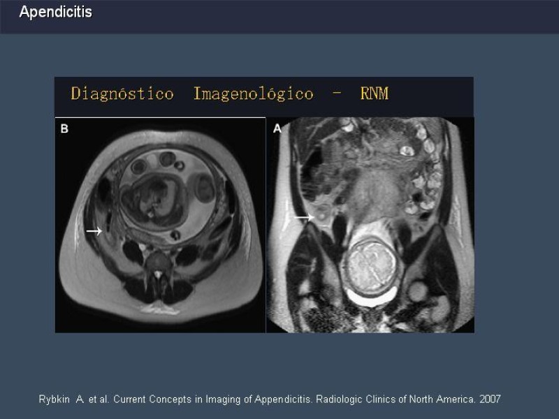Diapositiva 24 de Apendicitis