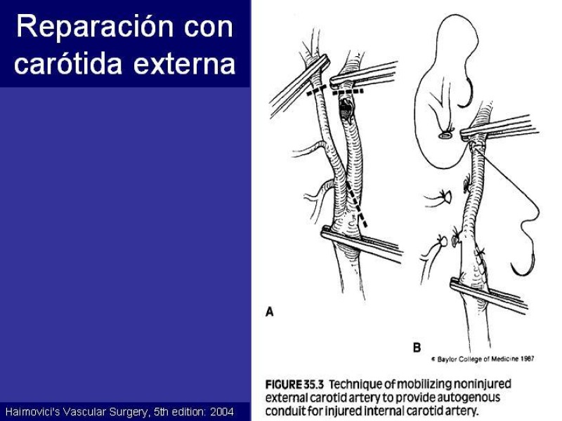 Diapositiva 53 de Trauma Cervical Penetrante