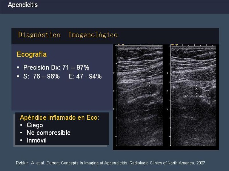Diapositiva 17 de Apendicitis
