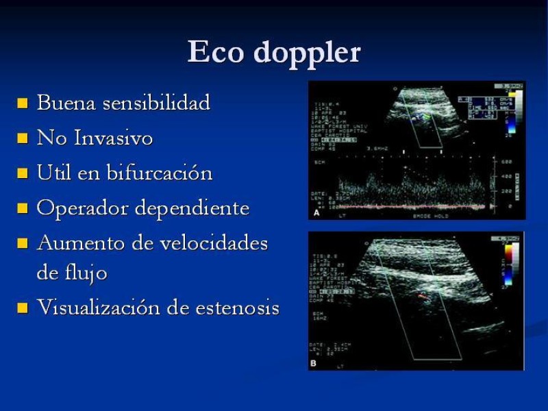Diapositiva 7 de Estenosis Carotidea Endarterectomía y Angioplastía