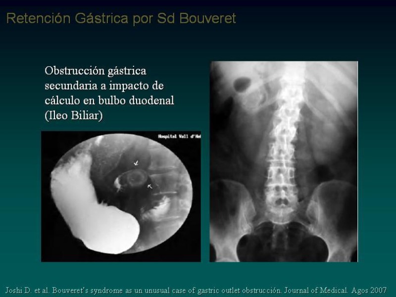Diapositiva 9 de Síndrome Retención Gástrica