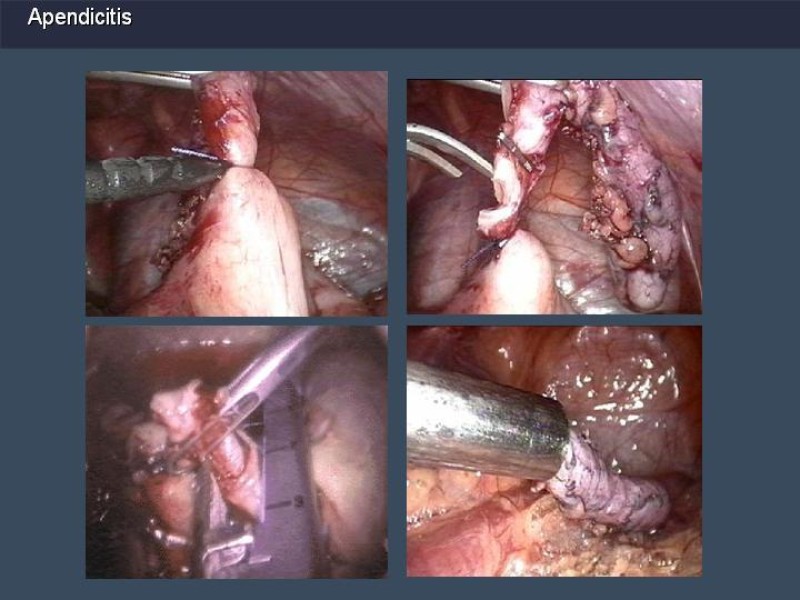 Diapositiva 30 de Apendicitis