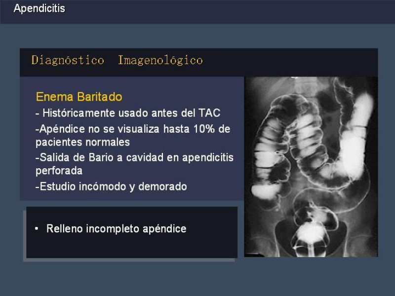 Diapositiva 15 de Apendicitis