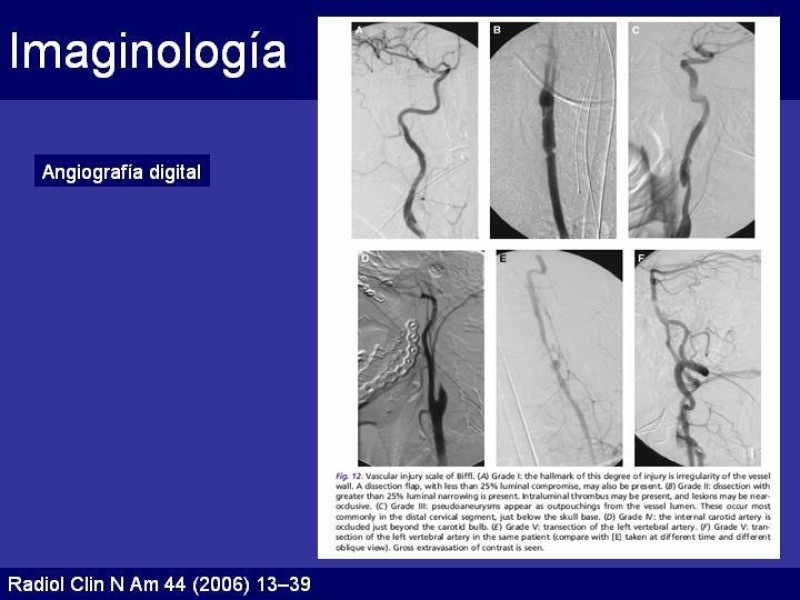 Diapositiva 19 de Trauma Cervical Penetrante