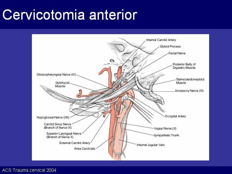 Diapositiva 39 de Trauma Cervical Penetrante