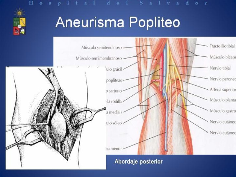 Diapositiva 16 de Aneurismas Arteriales de Extremidades Inferiores 