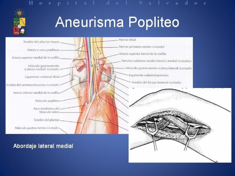 Diapositiva 15 de Aneurismas Arteriales de Extremidades Inferiores 