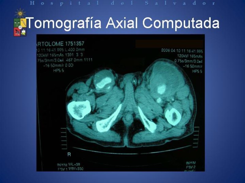 Diapositiva 6 de Aneurismas Arteriales de Extremidades Inferiores 