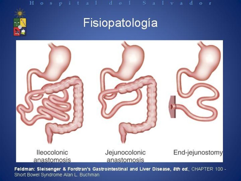Diapositiva 11 de Síndrome de intestino corto
