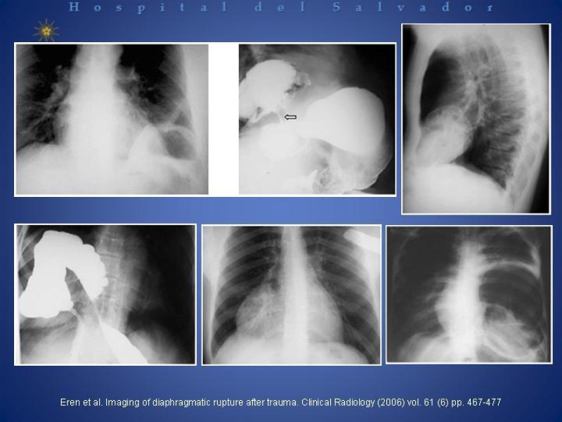 Diapositiva 9 de Trauma Diafragmático
