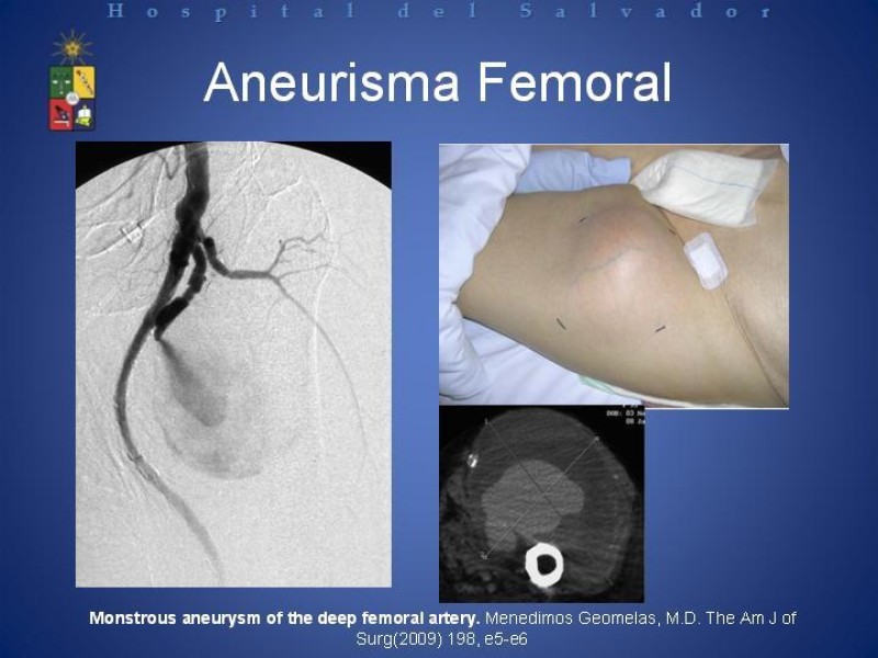 Diapositiva 26 de Aneurismas Arteriales de Extremidades Inferiores 