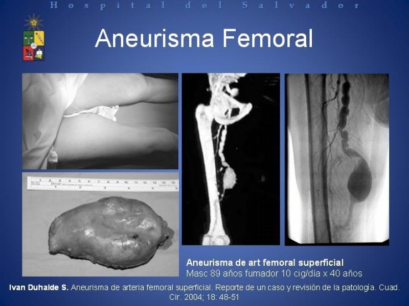 Diapositiva 25 de Aneurismas Arteriales de Extremidades Inferiores 