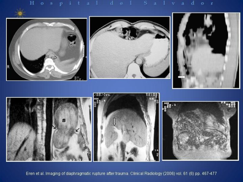 Diapositiva 11 de Trauma Diafragmático