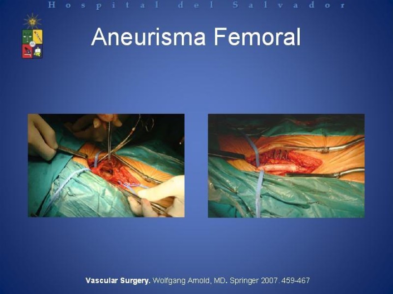 Diapositiva 24 de Aneurismas Arteriales de Extremidades Inferiores 