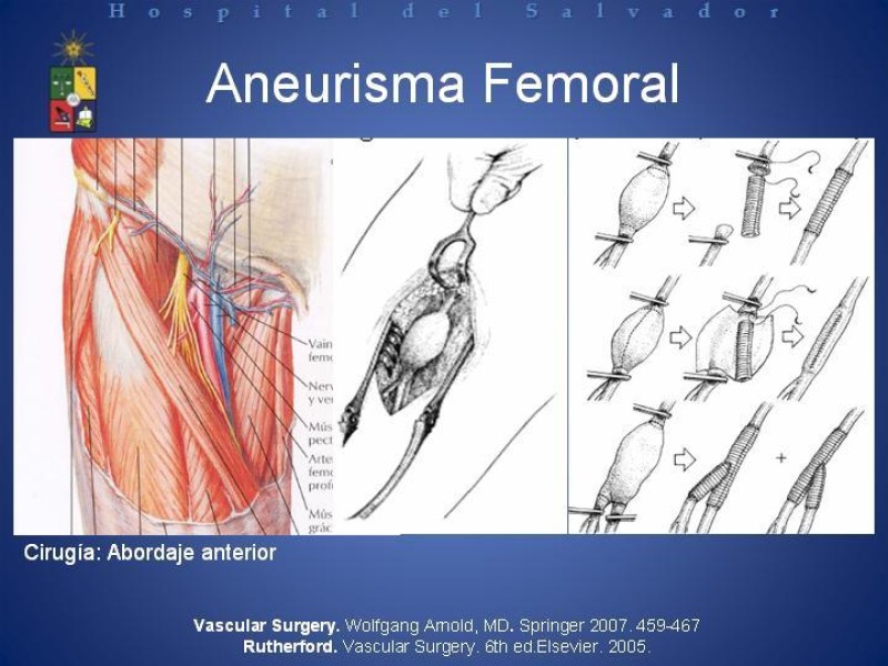 Diapositiva 23 de Aneurismas Arteriales de Extremidades Inferiores 