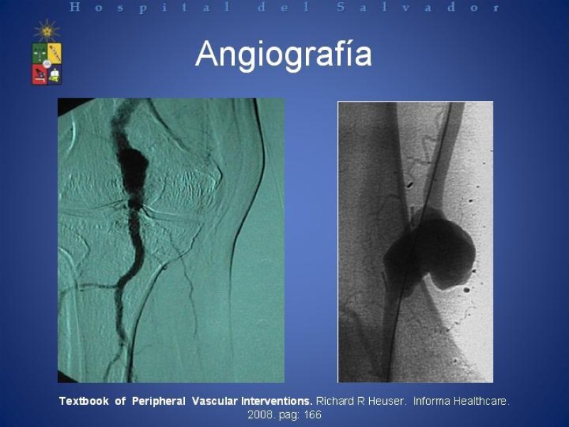 Diapositiva 5 de Aneurismas Arteriales de Extremidades Inferiores 