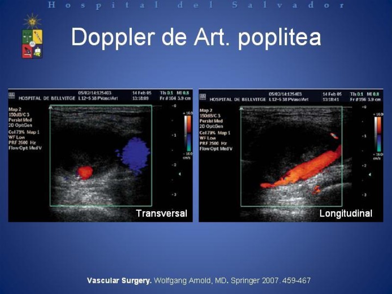 Diapositiva 4 de Aneurismas Arteriales de Extremidades Inferiores 