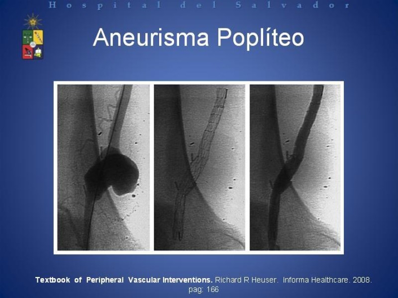 Diapositiva 18 de Aneurismas Arteriales de Extremidades Inferiores 