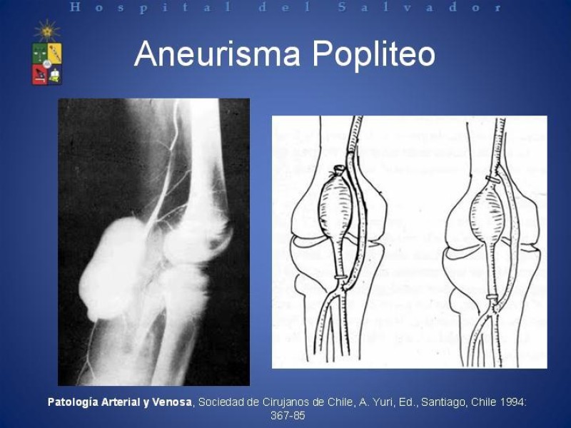 Diapositiva 14 de Aneurismas Arteriales de Extremidades Inferiores 