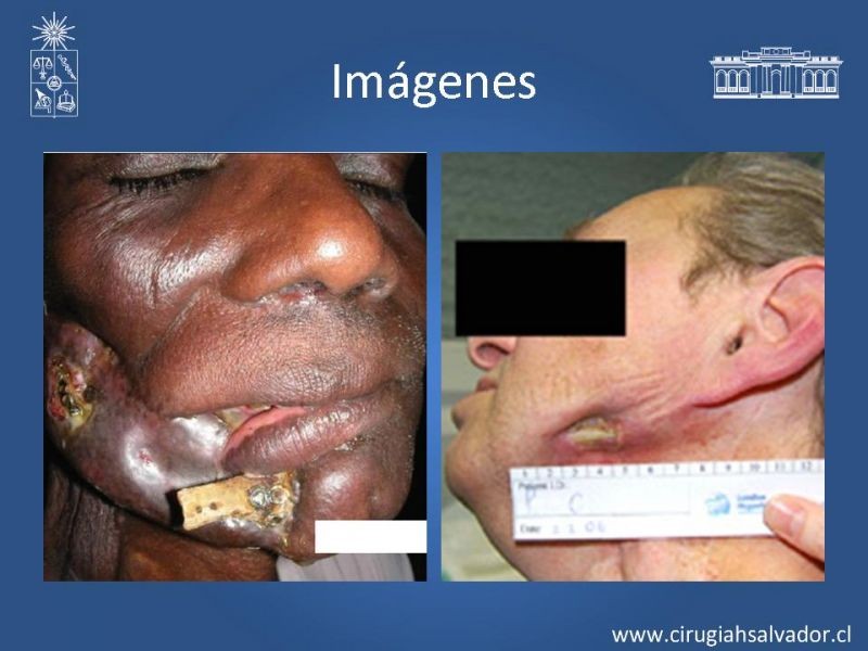 Diapositiva 12 de Osteorradionecrosis