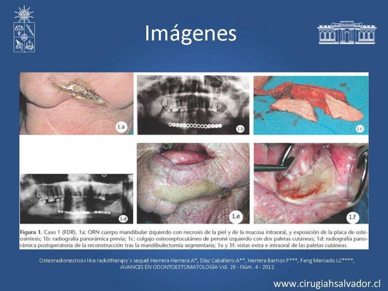 Diapositiva 11 de Osteorradionecrosis