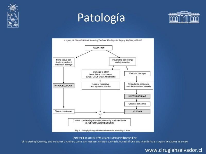 Diapositiva 4 de Osteorradionecrosis