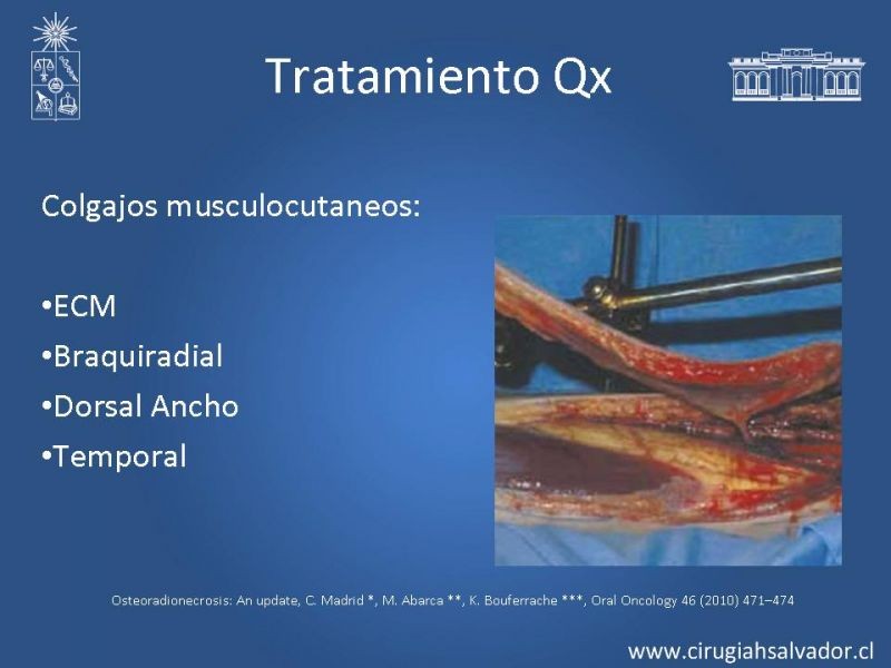 Diapositiva 22 de Osteorradionecrosis