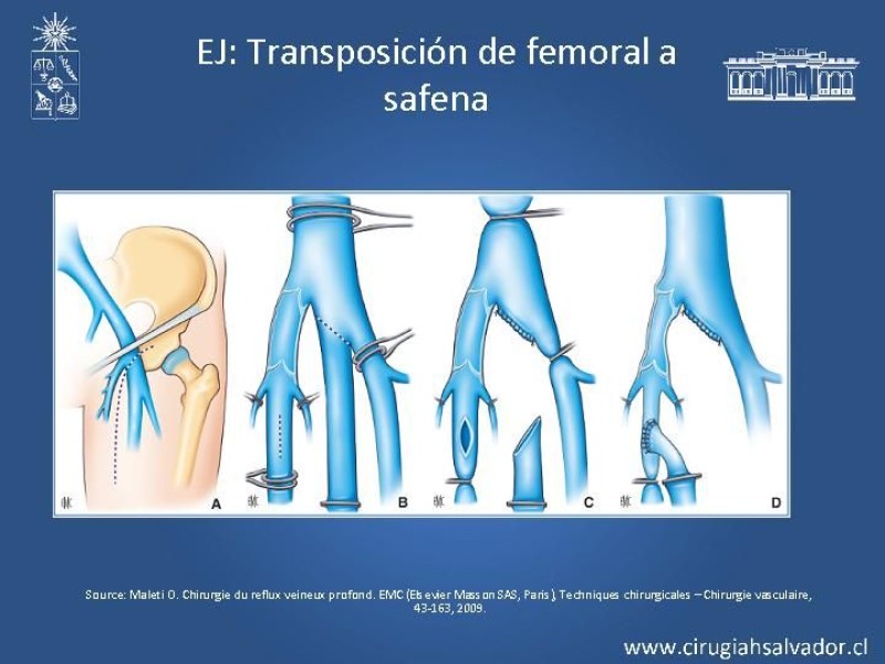 Diapositiva 22 de Síndrome Postrombótico
