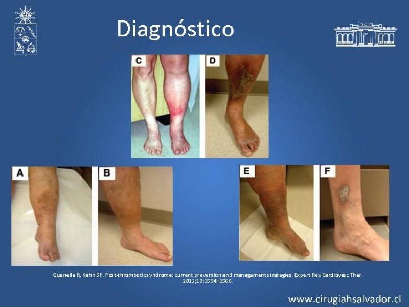 Diapositiva 7 de Síndrome Postrombótico