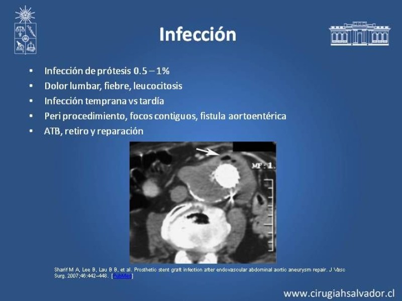 Diapositiva 15 de Complicaciones de EVAR