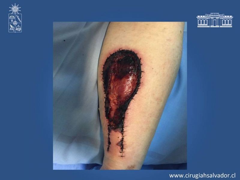 Diapositiva 15 de Colgajos musculocutáneos