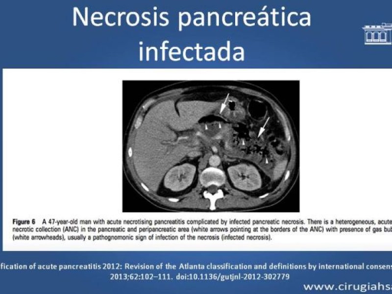 Diapositiva 12 de Antibióticos y antifúngicos en pancreatitis, indicaciones y tratamiento