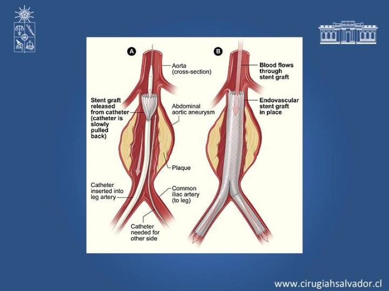 Diapositiva 4 de Complicaciones de EVAR
