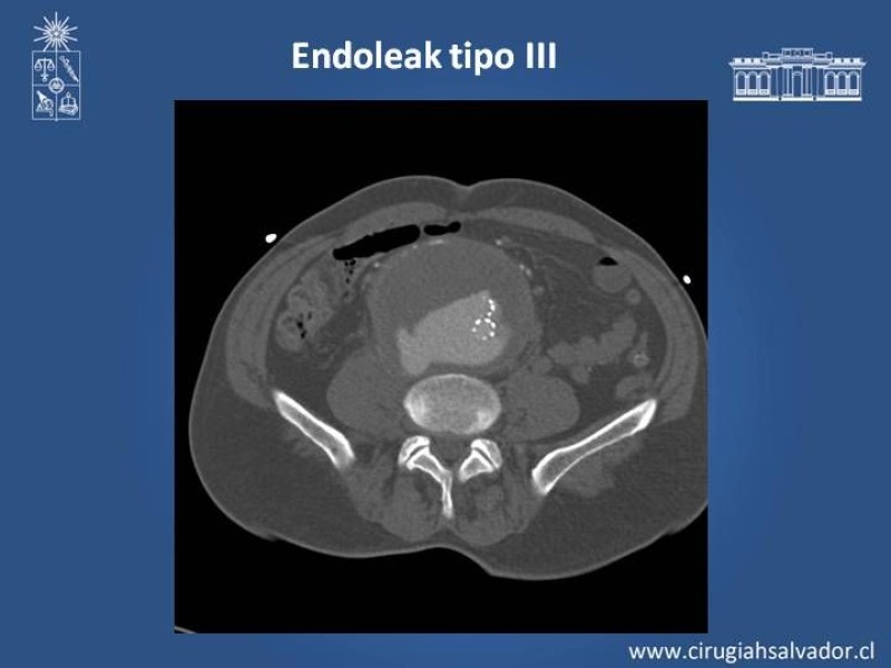 Diapositiva 11 de Complicaciones de EVAR