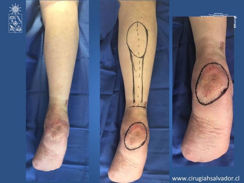 Diapositiva 13 de Colgajos musculocutáneos