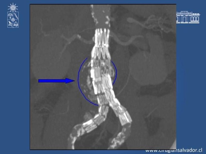 Diapositiva 5 de Complicaciones de EVAR