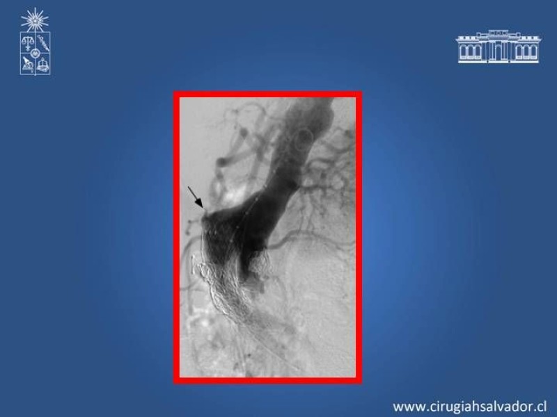 Diapositiva 13 de Complicaciones de EVAR