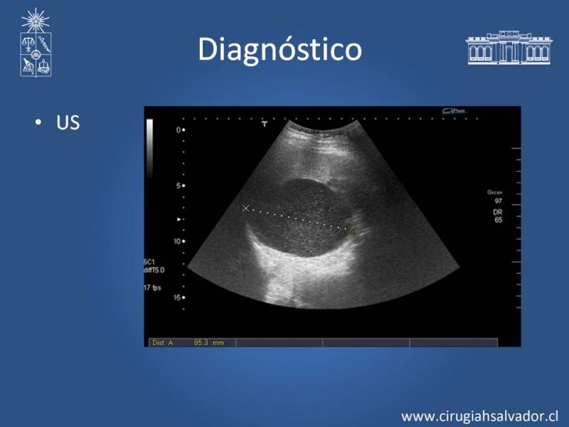 Diapositiva 9 de Quistes esplénicos