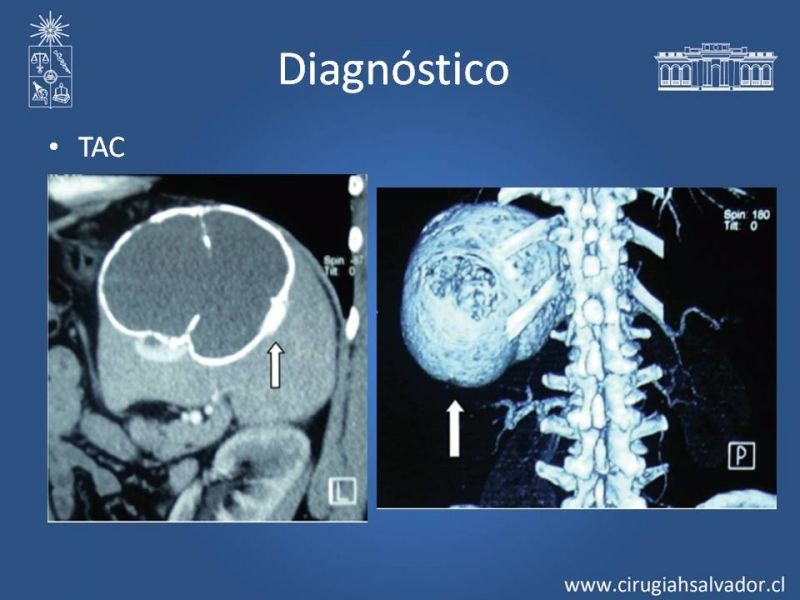 Diapositiva 11 de Quistes esplénicos