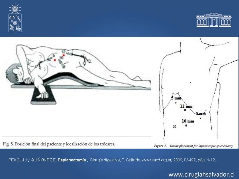 Diapositiva 19 de Quistes esplénicos
