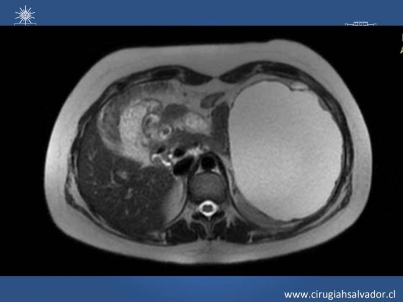 Diapositiva 2 de Quistes esplénicos