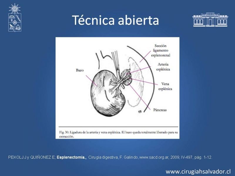 Diapositiva 23 de Quistes esplénicos